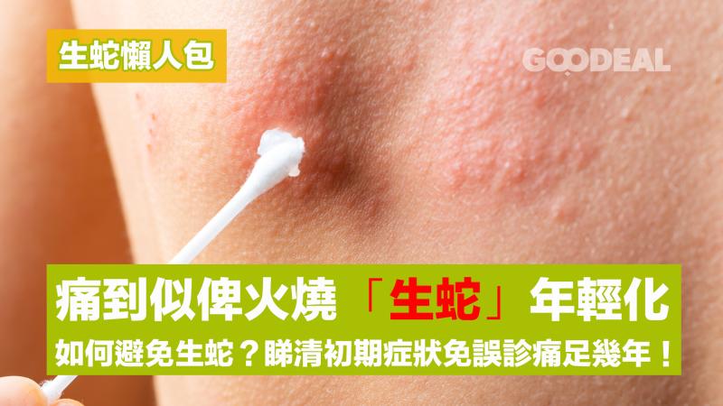 生蛇懶人包｜痛到似俾火燒 「生蛇」年輕化 如何避免生蛇？睇清初期症狀免誤診痛足幾年！